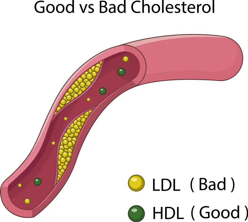 ศิลปะการจัดการ LDL แบบไม่เครียด
